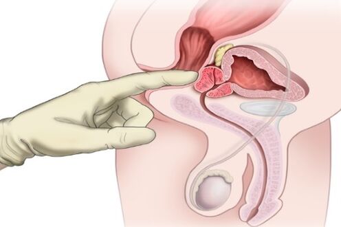 Prostate massage to treat prostatitis