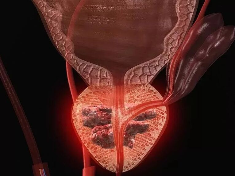 Male prostatitis