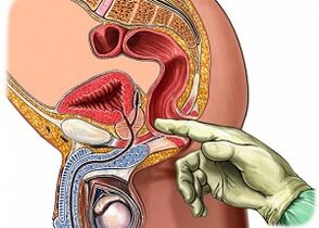 Prostate massage for prostatitis