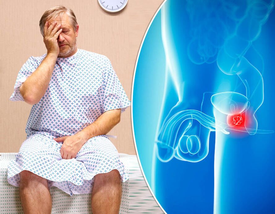 A man with prostatitis receives a diagnosis of the disease
