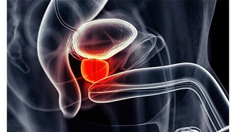 Inflammation of the prostate