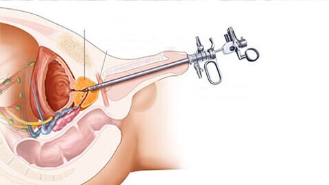 Surgery treatment of prostatitis