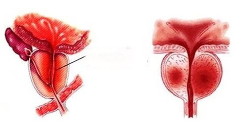 What is chronic prostatitis like